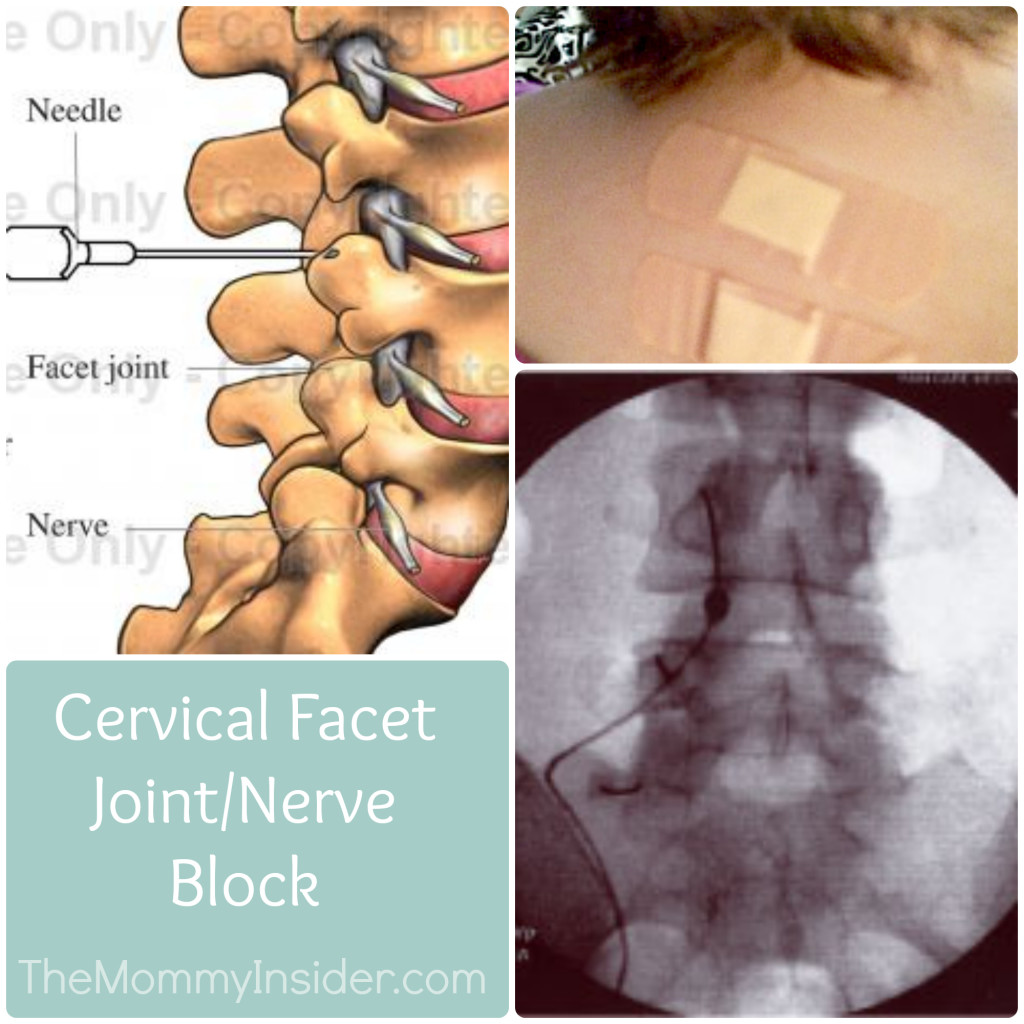 Cervical Facet Joint and Nerve Block